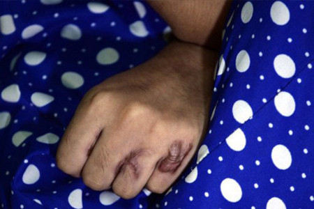 Hindistan’da bir kadına beşinci kez asit saldırısı